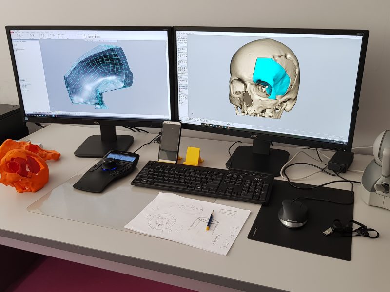 Zdjęcie prezentujące - Meet Facialtech – a new Individual Medical Implant from Bionanopark